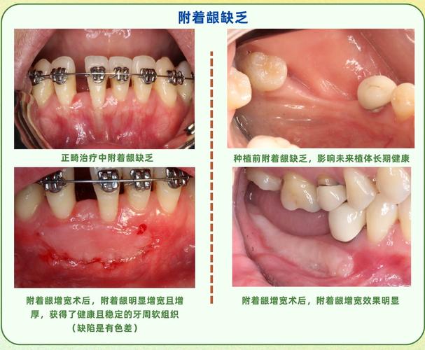 龈下刮治后多久能开始正畸？-图2