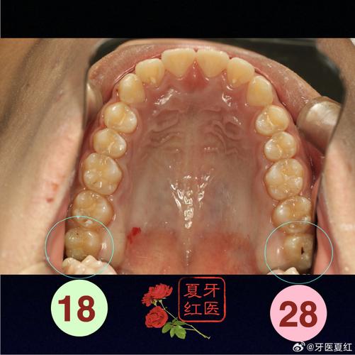 正畸深覆盖拔2颗牙-图3