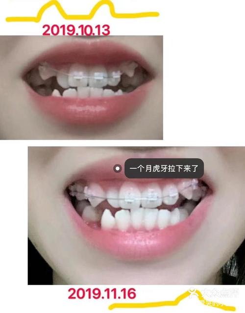 虎牙可以种牙嘛-图3