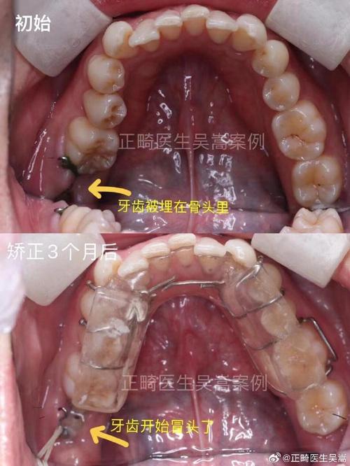 正畸下合磨牙舌倾6-图3