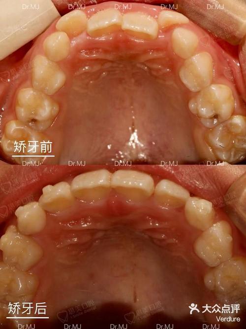 正畸下合磨牙舌倾6-图2