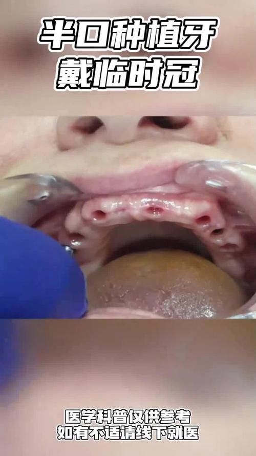 种牙无菌没做好-图1 种牙无菌没做好-图1