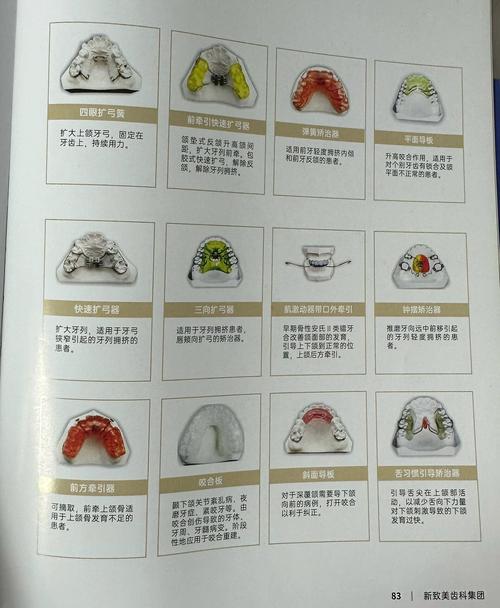 正畸推簧什么时候用-图3