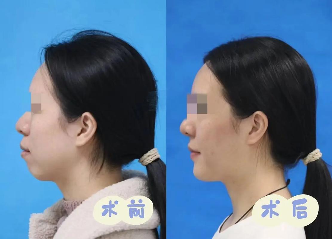 正颌手术不需要正畸-图3