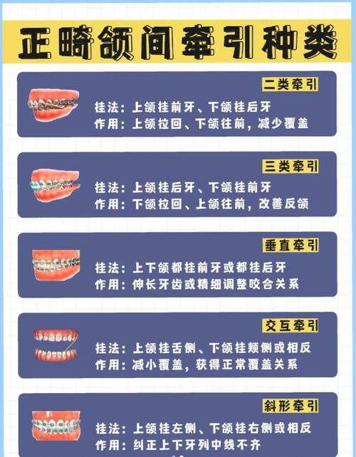 口腔正畸2类牵引力-图2