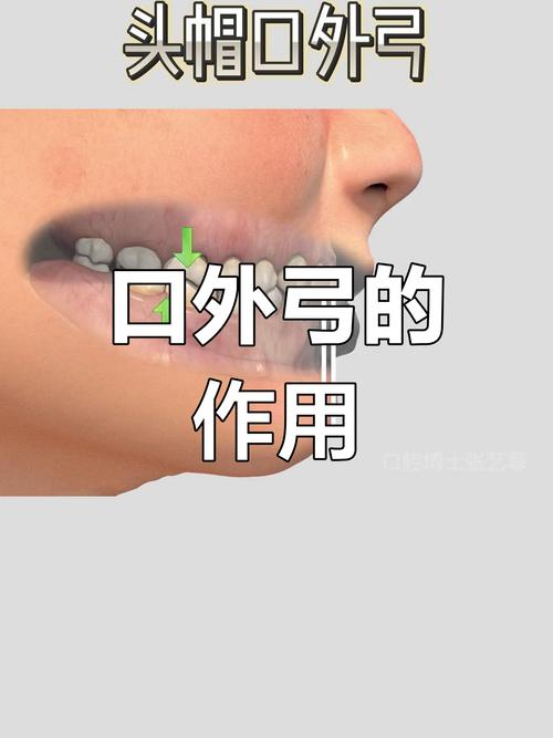 正畸口外弓的适应症-图3