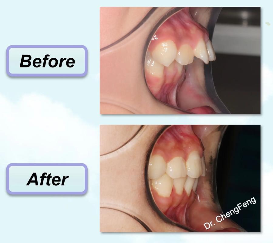 正畸拔牙间隙变化图-图3