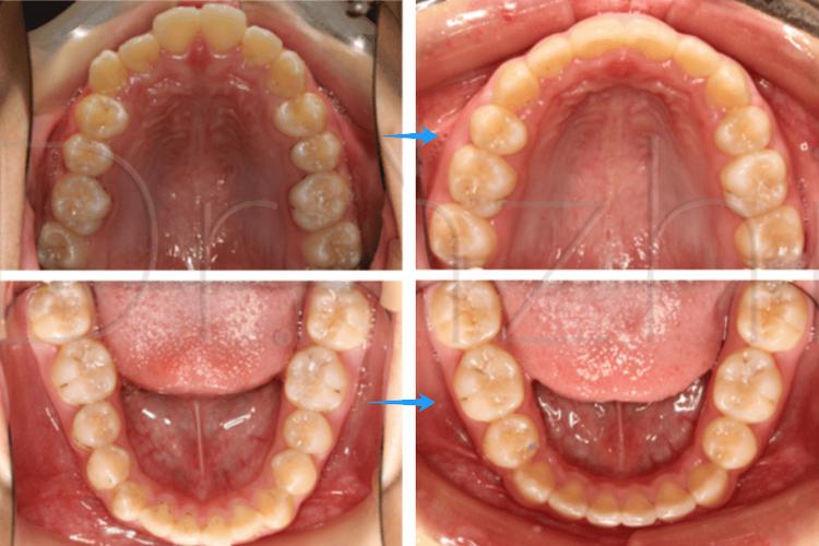 正畸拔牙间隙变化图-图2