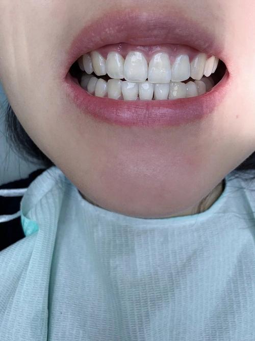 怀孕种牙会怎样-图2