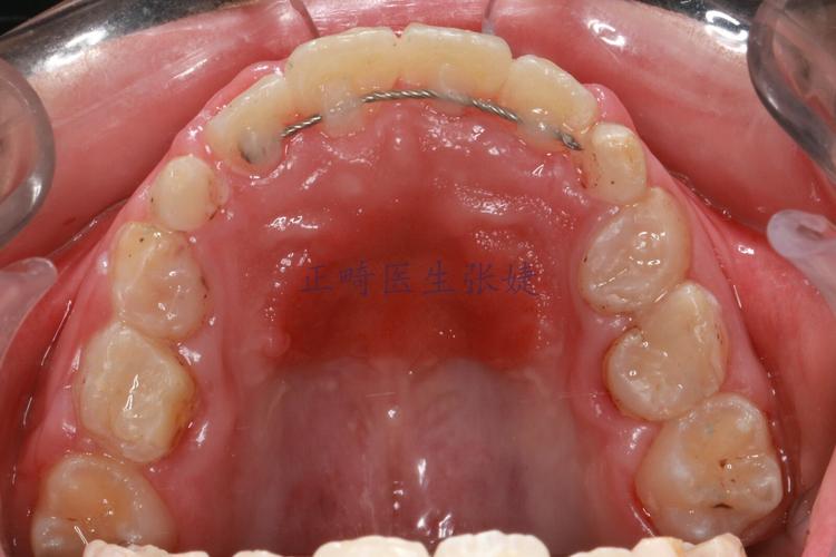 牙齿正畸把牙拉出来-图1 牙齿正畸把牙拉出来-图1