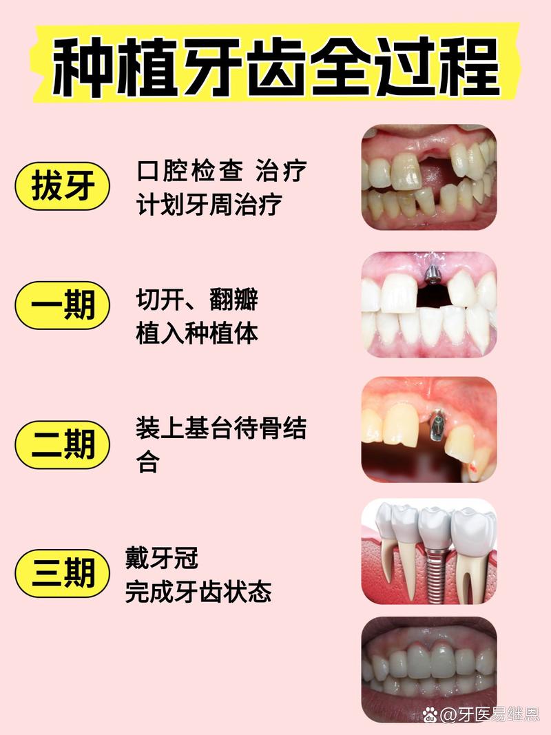 种牙得有牙根吗-图2