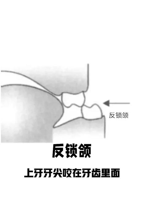 咬颌在正畸中的意义-图2