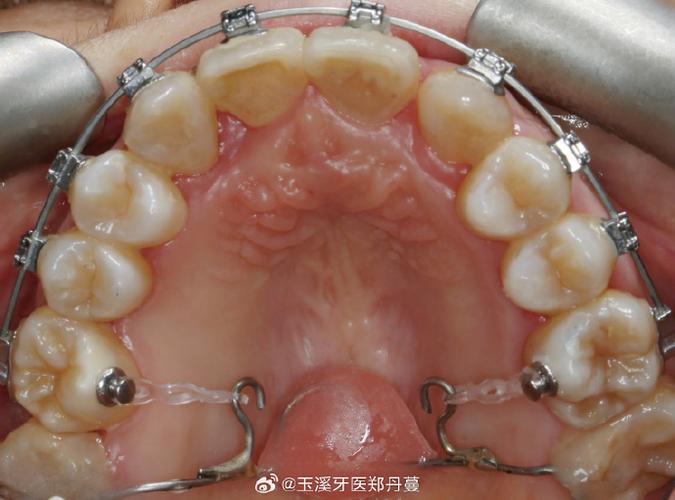 正畸人字曲弯制怎么学？视频演示弯制技巧与步骤-图3