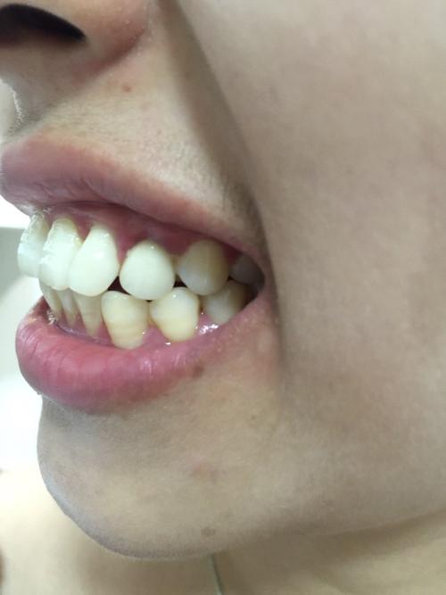 一颗大牙往外突影响美观，正畸矫正能改善吗？-图2