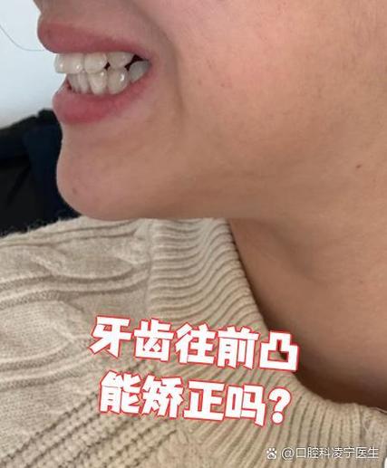 一颗大牙往外突影响美观，正畸矫正能改善吗？-图3