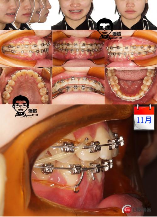 正畸颊面管粘接图片-图3