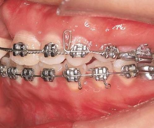 正畸理想弓弯制图片-图2