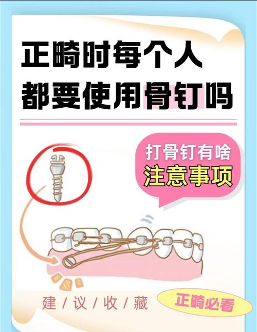 正畸牙为什么打骨钉-图1