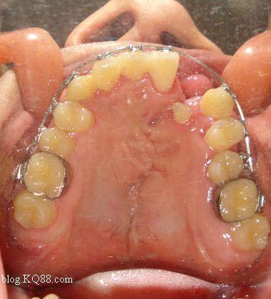 植骨术后全口正畸，何时介入最合适？-图1