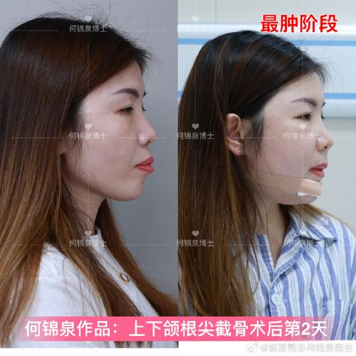 植骨术后全口正畸，何时介入最合适？-图3