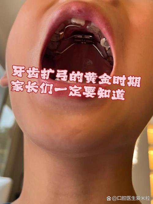 牙齿正畸扩弓治疗会疼吗？-图2