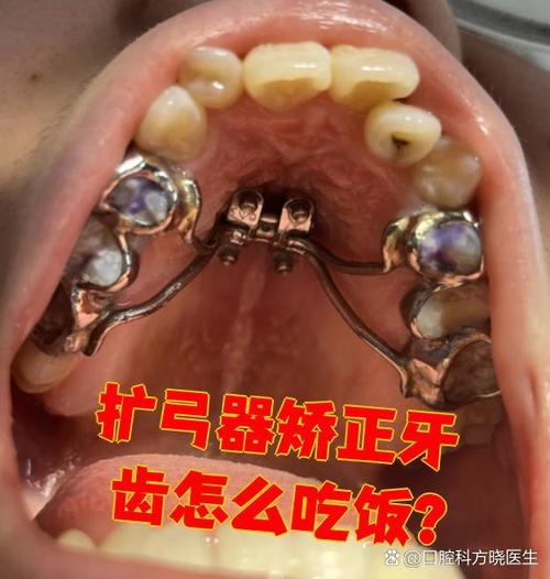 牙齿正畸扩弓治疗会疼吗？-图3