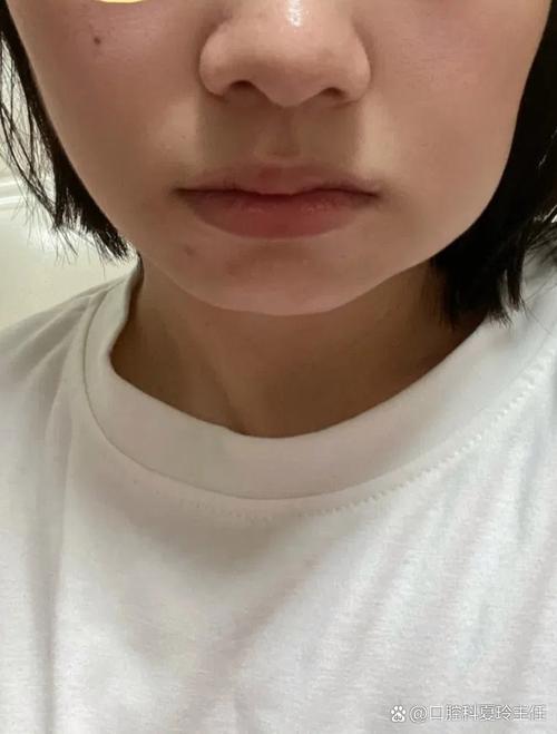 种牙之后脸肿了-图1