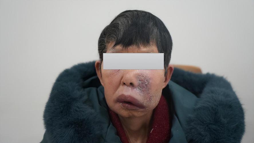 种牙之后脸肿了-图3