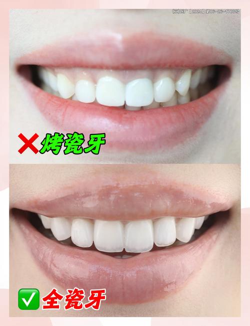 深圳种牙和烤瓷-图3 深圳种牙和烤瓷-图3