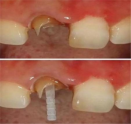 补牙打桩和种牙，牙齿修复该如何正确选择？-图2