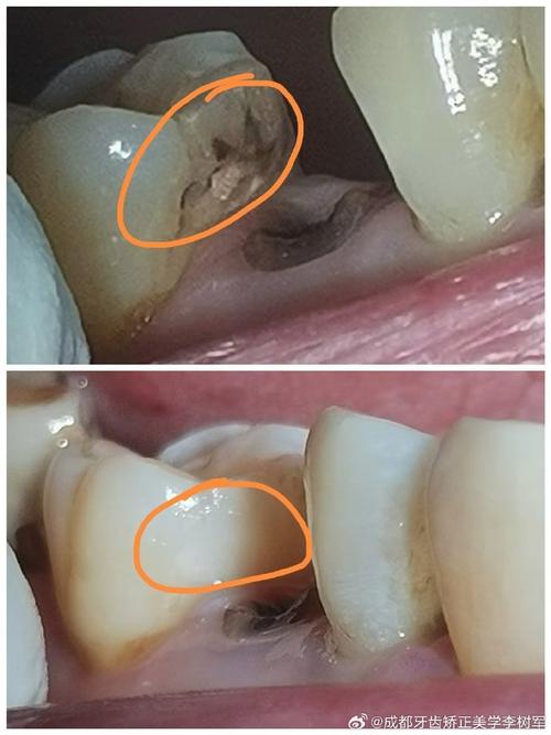 邻面龋患者能做正畸吗？-图2