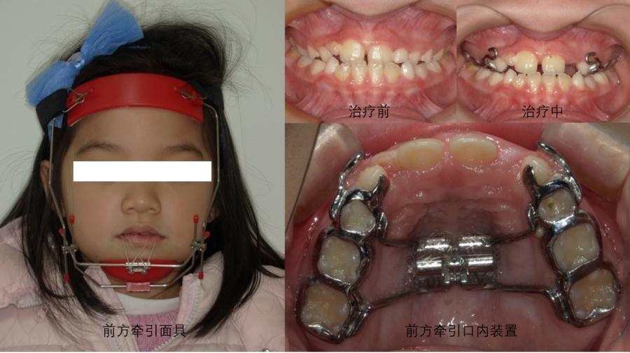 正畸牵引钩滑动内收的操作要点及支抗控制方法是什么？-图1