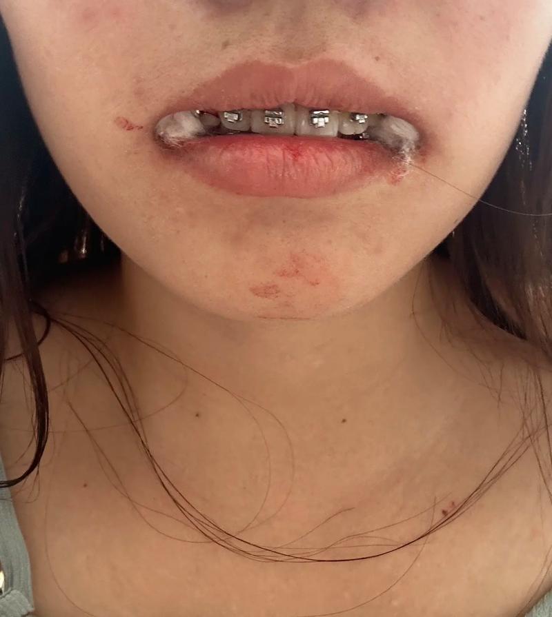 拔了四个牙，为何最终放弃正畸？-图3