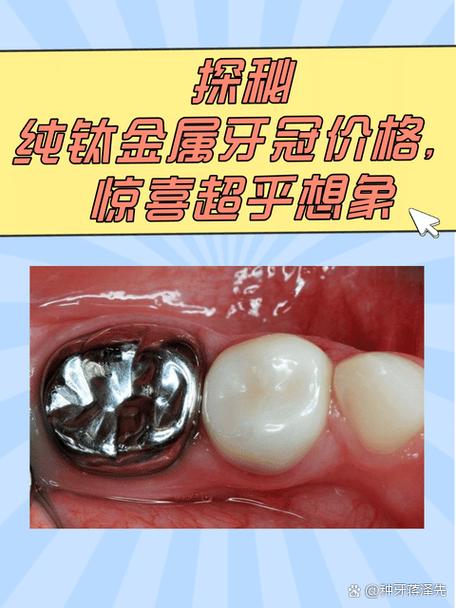 金属牙分哪几种？常见种类有哪些？-图1