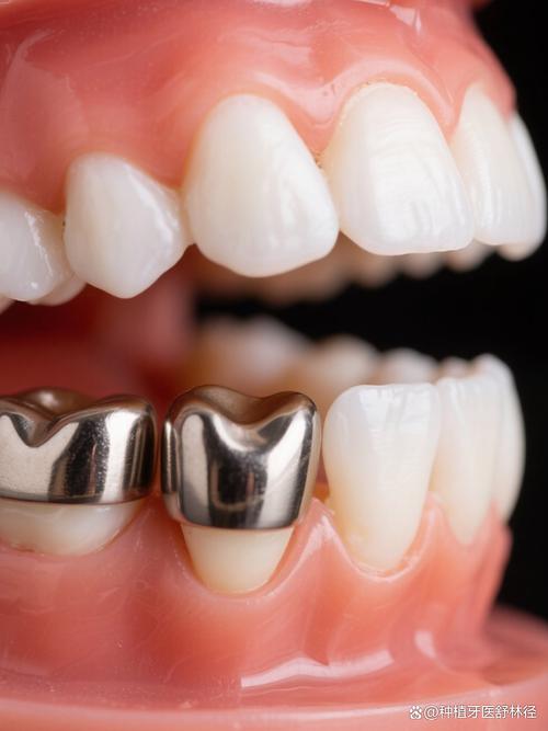 金属牙分哪几种？常见种类有哪些？-图3