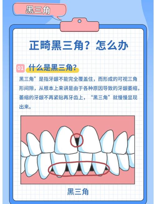 正畸黑三角如何去除-图2