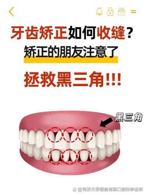 正畸黑三角如何去除-图1