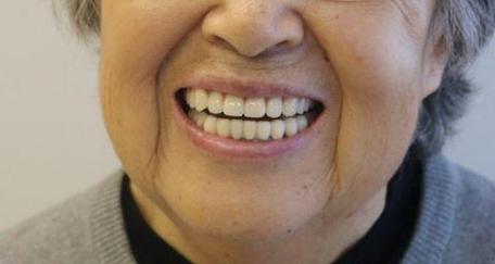 65岁以上种牙安全吗？效果能维持多久？-图2