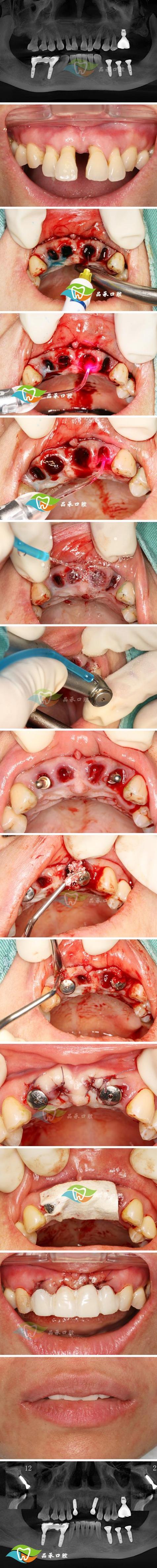 65岁以上种牙安全吗？效果能维持多久？-图3