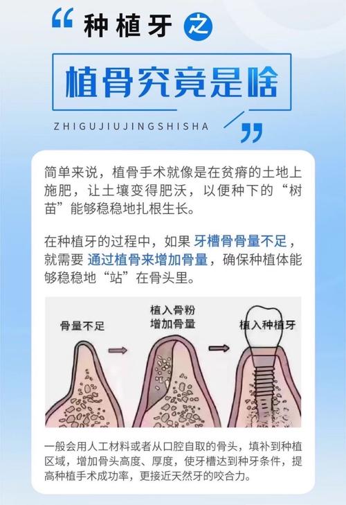 种牙植骨会影响说话功能恢复吗？-图2