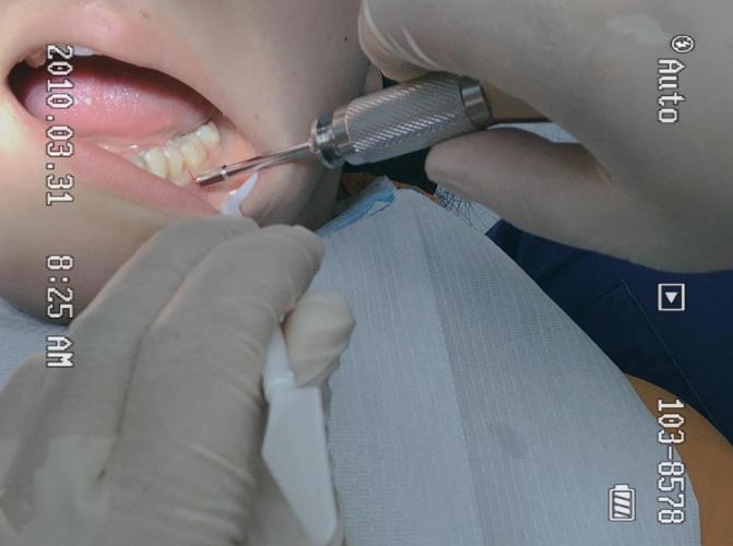 种牙钉有点晃动-图2 种牙钉有点晃动-图2