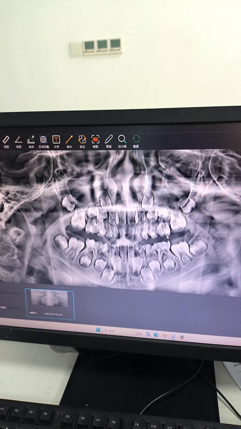 种牙前，锥形束CT检查为何必不可少？-图2