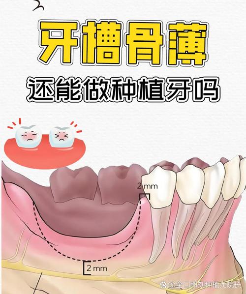 正畸 骨量少要植骨-图1