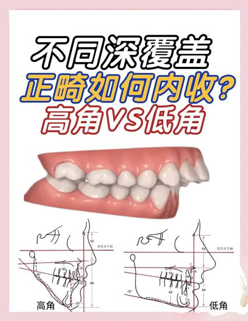 正畸U矫正器，该放上颌还是下颌？-图1
