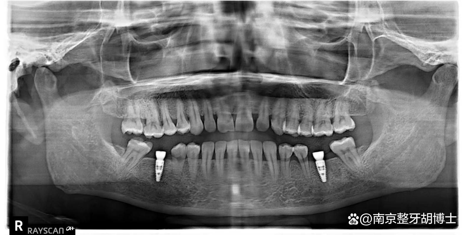 南京种牙哪边好？求靠谱机构推荐？-图1
