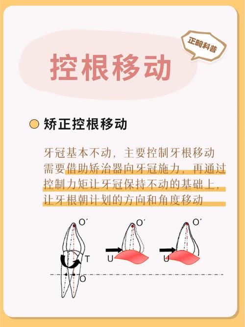 正畸控根簧弯制方法-图2 正畸控根簧弯制方法-图2