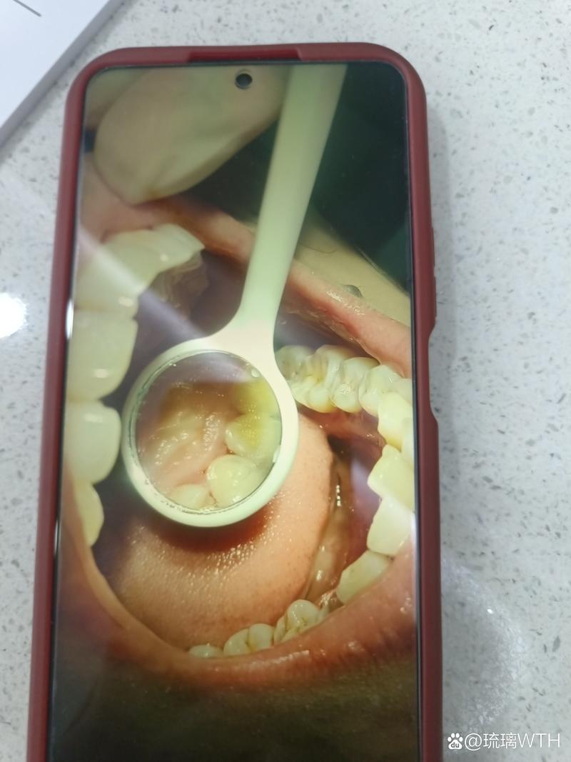 牙博士洗牙有两种,哪种更适合你的牙齿状况?-图3 牙博士洗牙有两种,哪种更适合你的牙齿状况?-图3