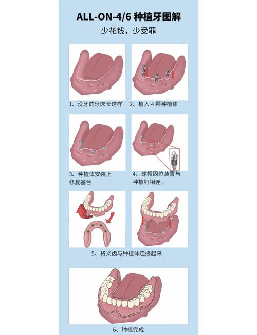 少颗牙要种牙吗-图3