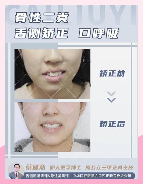 正畸露龈笑矫正时间-图2