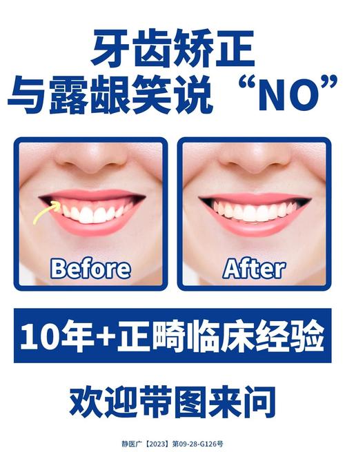 正畸露龈笑解决方案-图1
